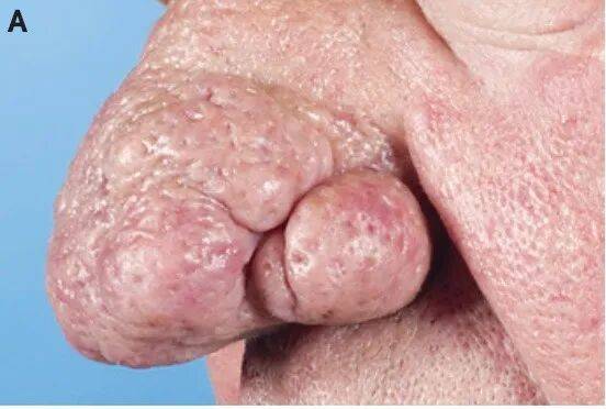 美麗的誤會：當“玫瑰”不是花，而是玫瑰痤瘡