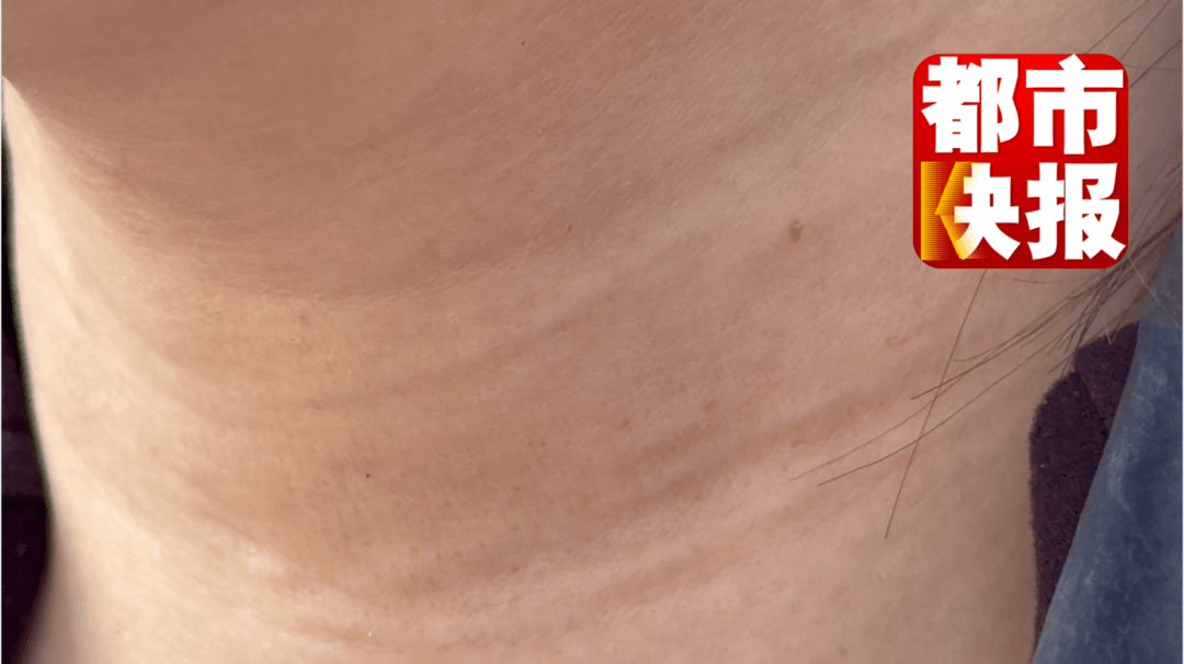 女子做頸部皺紋4年修復6次，醫療美容機構回應：只修復不退費，涉事醫生全部離職